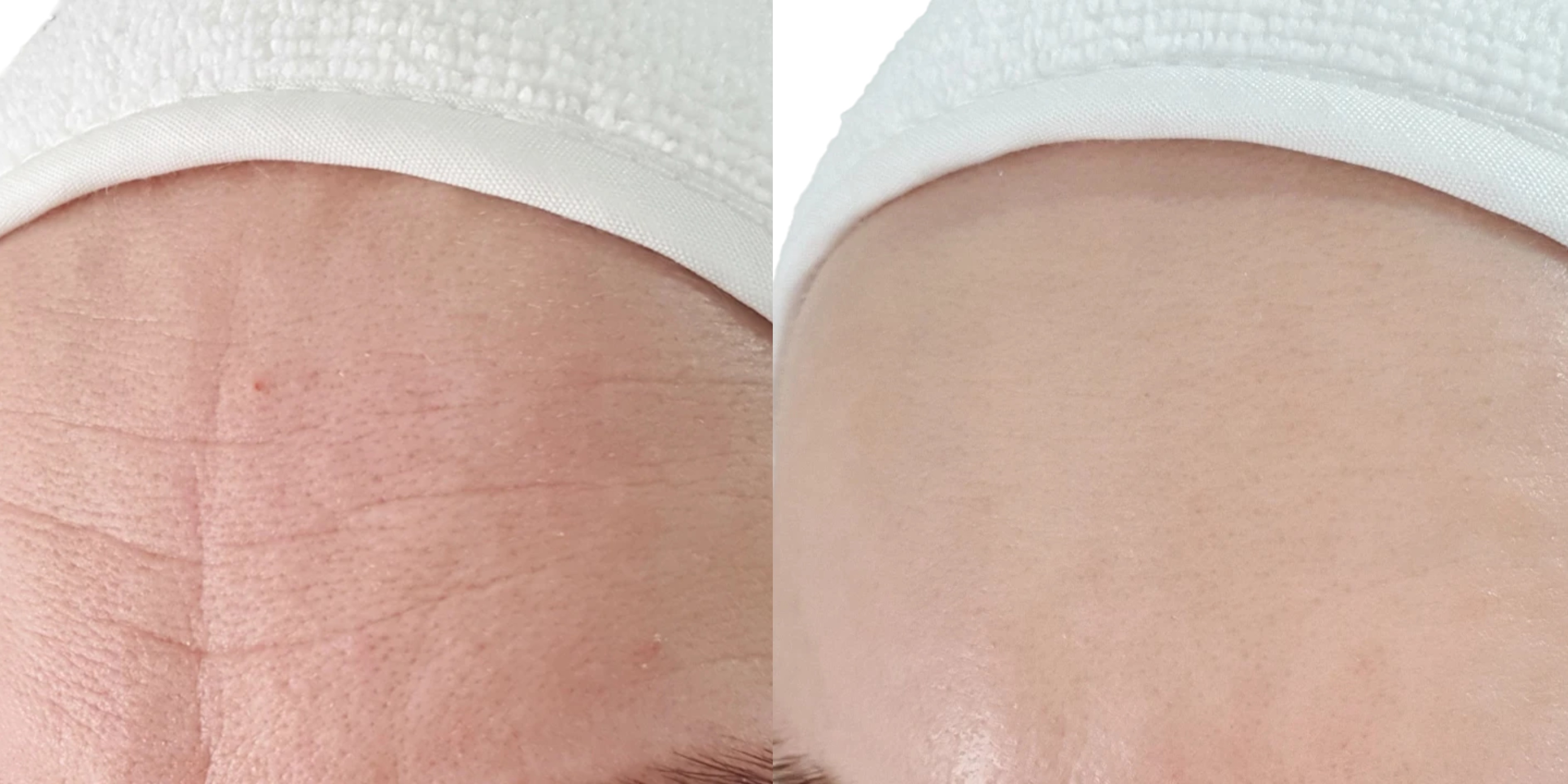 Resultados Dermapen4